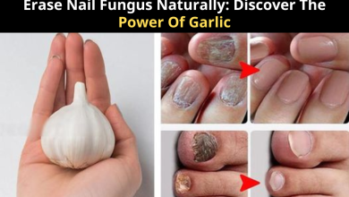 Erase Nail Fungus Naturally: Discover The Power Of Garlic